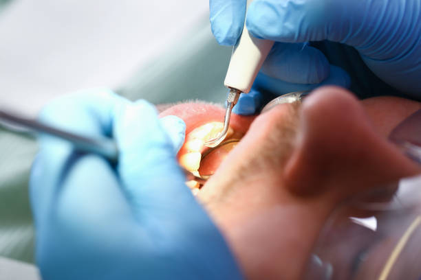 Best Emergency Tooth Extraction in Knox, PA